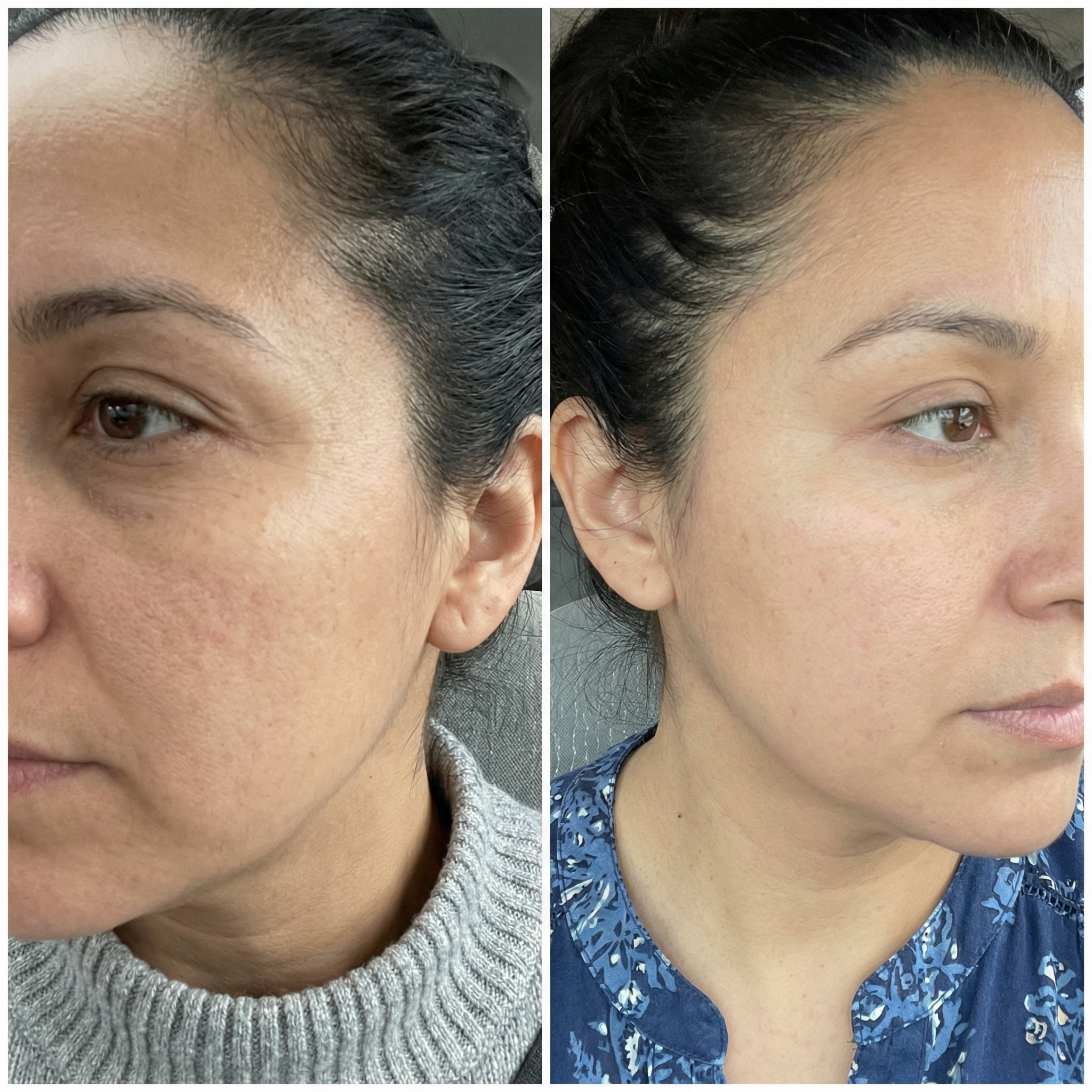 Cuando Las Cremas No Alcanzan: Firmeza Visible Con 30 Péptidos Activos